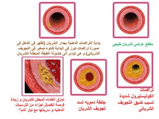 ‫بداٌة التراكمات الدهنٌة بجدار الشرٌان (تظهر فى الشكل فى‬   ‫مقطع عرضى لشرٌان طبٌعى‬
     ‫صورة تراكمات تبرز فى البداٌة كنتوء صغٌر فى التجوٌف‬
    ‫الشرٌانً) و هى تؤدى الى خشونة الطبقة المبطنة للشرٌان‬




                                                                           ‫تراكمات‬
                                                                 ‫الكولٌستٌرول شدٌدة‬
‫تمزق الغشاء المبطن للشرٌان و زٌادة‬
   ‫فرصة انفصال اجزاء من الترسبات‬
                                           ‫جلطة دموٌه تسد‬        ‫تسبب ضٌق التجوٌف‬
      ‫الدهنٌه و سرٌانها مع تٌار الدم’’‬      ‫تجوٌف الشرٌان‬                  ‫الشرٌانى‬
 