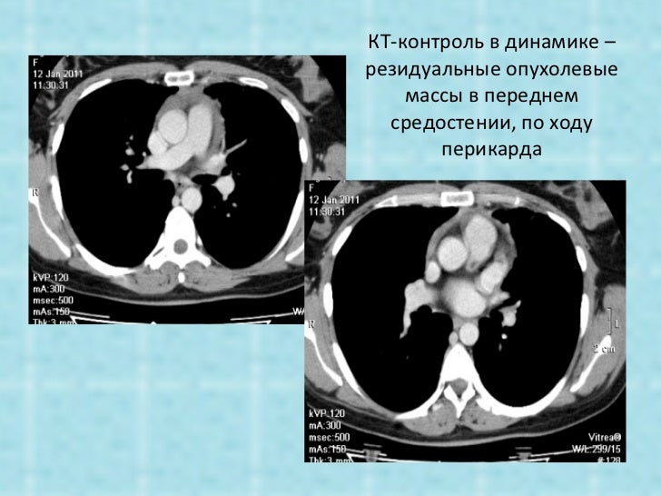 Неходжкинская лимфома с поражением вилочковой железы и надпочечников