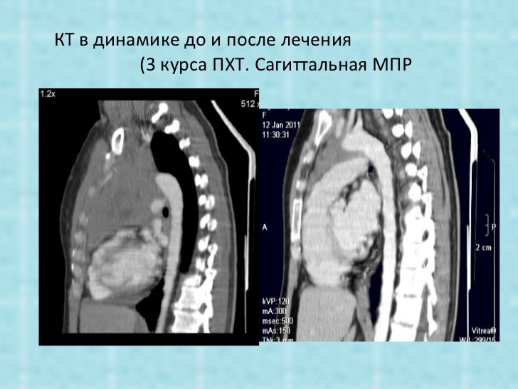 Неходжкинская лимфома с поражением вилочковой железы и надпочечников