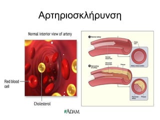 Αρτηριοσκλήρυνση