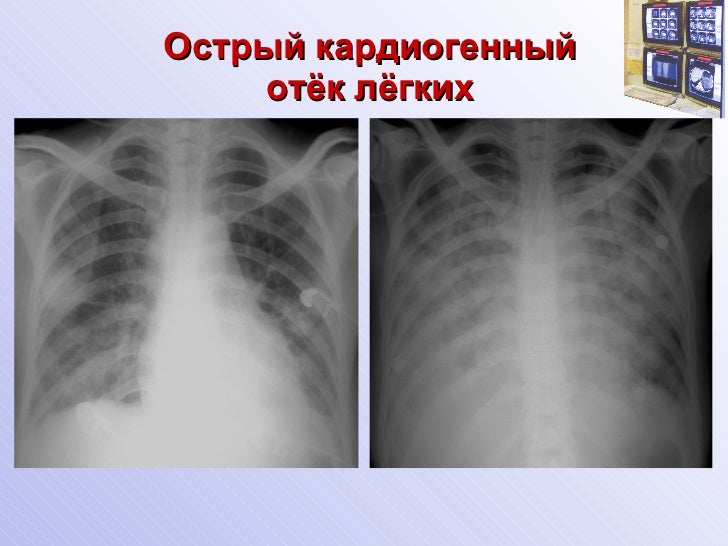 острый кардиогенный отек легких