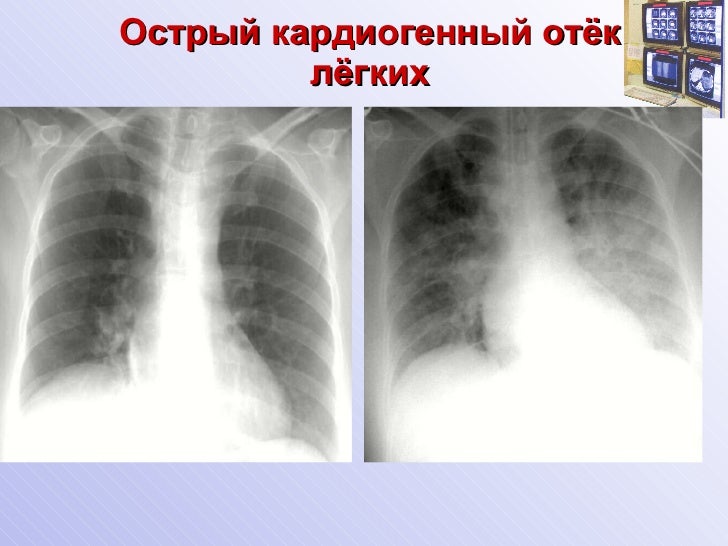 Отеки легких (1 часть)