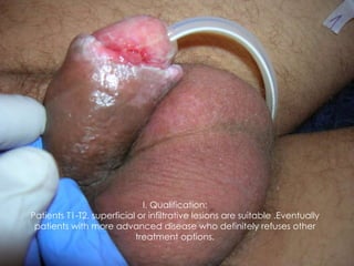 I. Qualification: Patients T1-T2, superficial or infiltrative lesions are suitable .Eventually patients with more advanced...