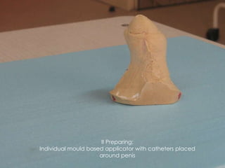 II Preparing: Individual mould based applicator with catheters placed around penis 