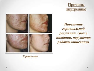 Причины
                    внутренние



                    Нарушение
                   гормональной
                 регуляции, сбои в
               питании, нарушения
                работы кишечника


Угревая сыпь
 