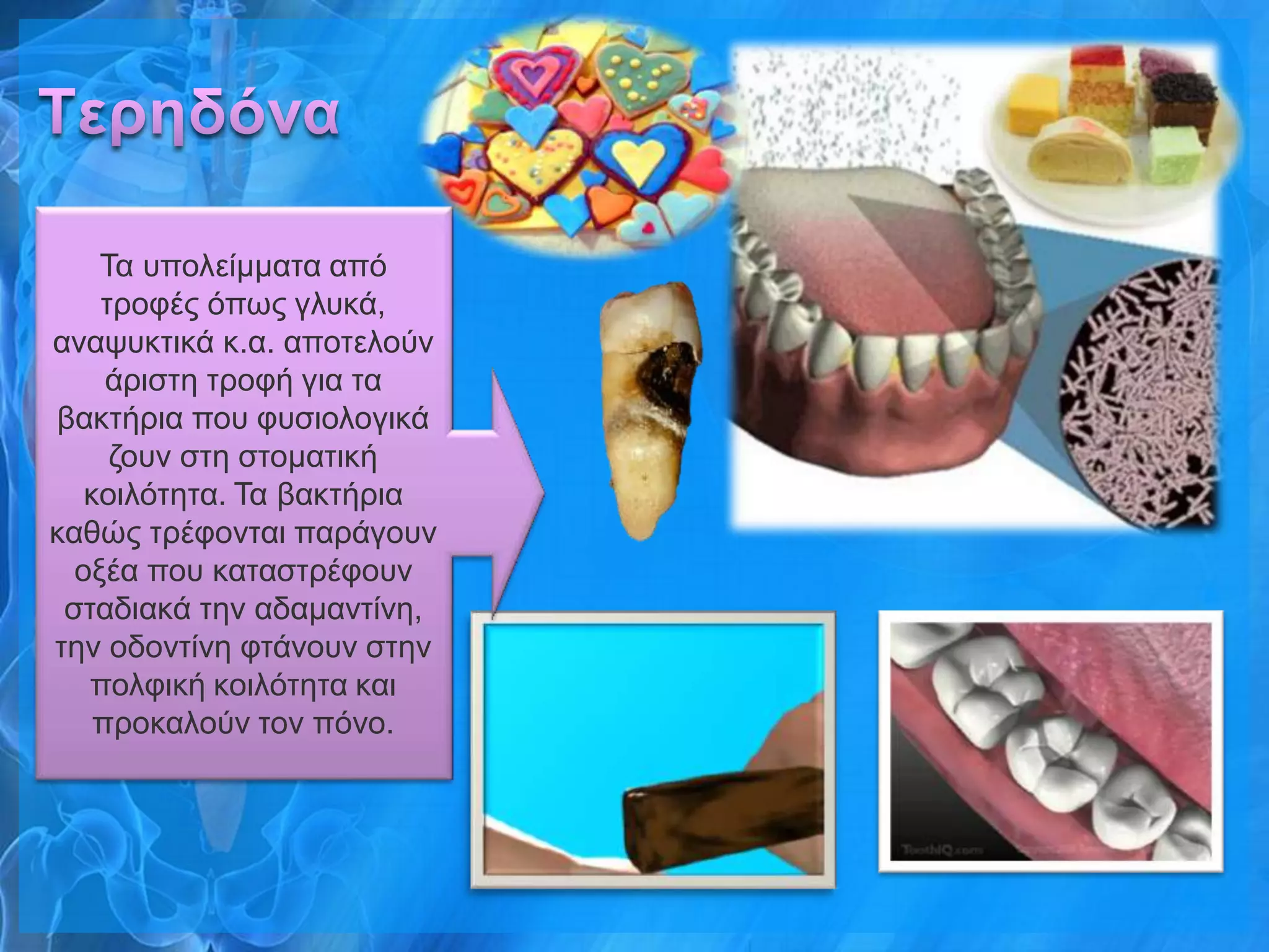 Τα ππνιείκκαηα από
    ηξνθέο όπσο γιπθά,
αλαςπθηηθά θ.α. απνηεινύλ
     άξηζηε ηξνθή γηα ηα
βαθηήξηα πνπ θπζηνινγηθά
     δνπλ ζηε ζηνκαηηθή
   θνηιόηεηα. Τα βαθηήξηα
θαζώο ηξέθνληαη παξάγνπλ
  νμέα πνπ θαηαζηξέθνπλ
 ζηαδηαθά ηελ αδακαληίλε,
ηελ νδνληίλε θηάλνπλ ζηελ
   πνιθηθή θνηιόηεηα θαη
    πξνθαινύλ ηνλ πόλν.
 