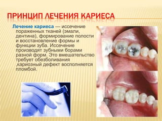 ПРИНЦИП ЛЕЧЕНИЯ КАРИЕСА
 Лечение кариеса — иссечение
  пораженных тканей (эмали,
  дентина), формирование полости
  и восстановление формы и
  функции зуба. Иссечение
  производят зубными борами
  разной форм. Это вмешательство
  требует обезболивания
  ,кариозный дефект восполняется
  пломбой.
 