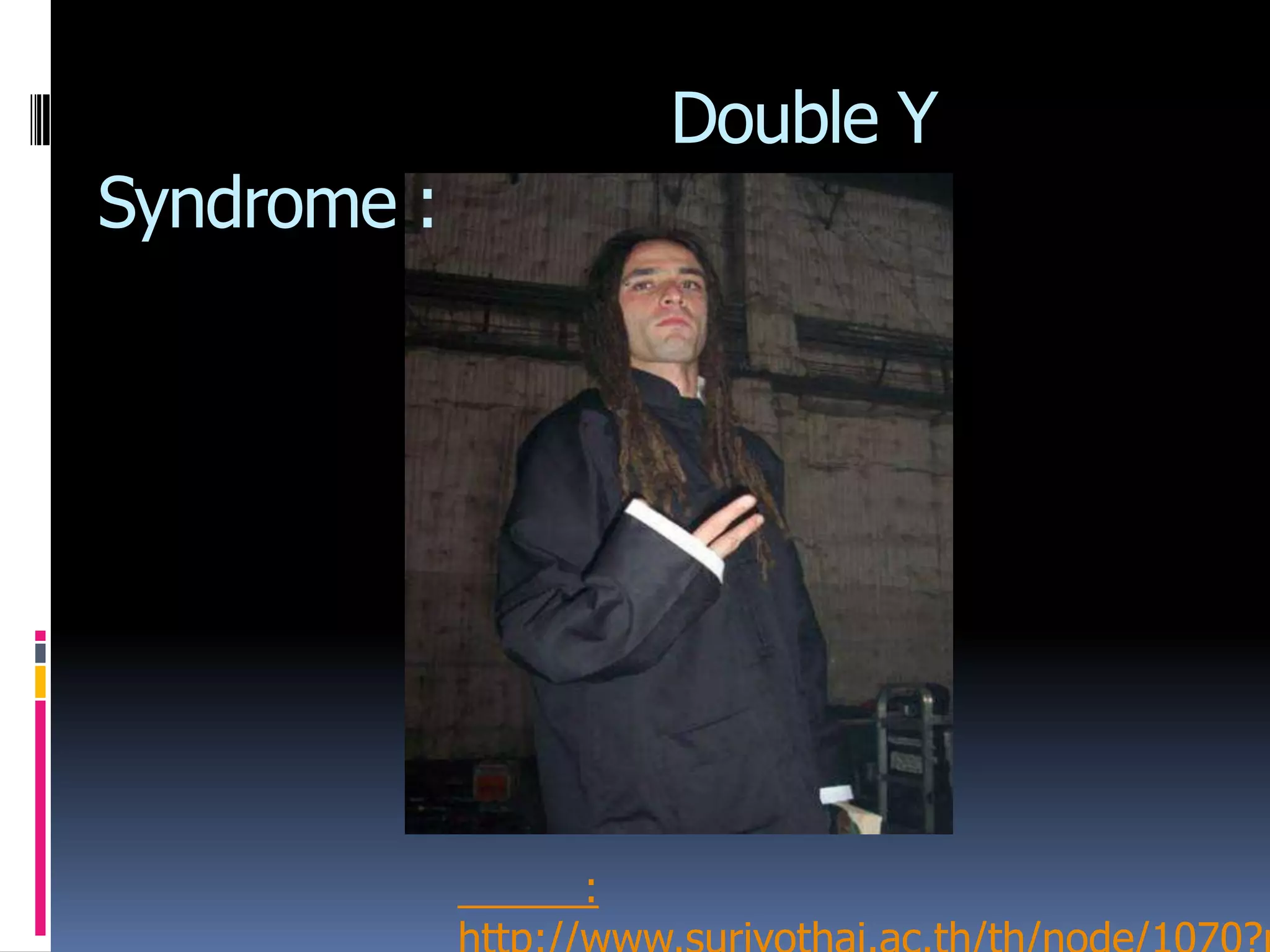 Double Y
Syndrome :
: