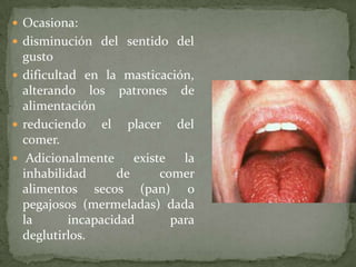  Ocasiona:
 disminución del sentido del
  gusto
 dificultad en la masticación,
  alterando los patrones de
  alimentación
 reduciendo el placer del
  comer.
 Adicionalmente      existe   la
  inhabilidad      de      comer
  alimentos secos (pan) o
  pegajosos (mermeladas) dada
  la       incapacidad       para
  deglutirlos.
 