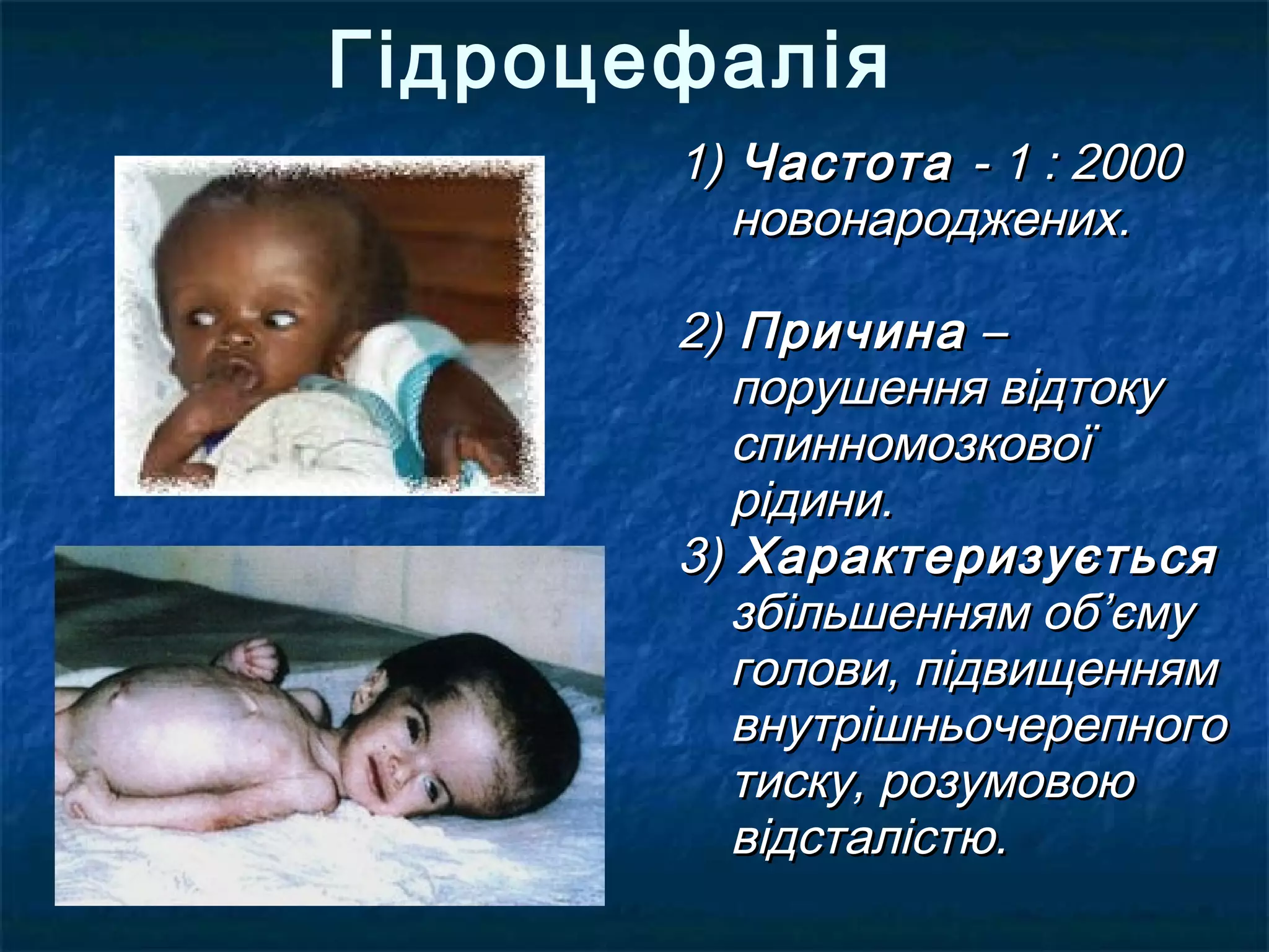 Гідроцефалія
       1) Частота - 1 : 2000
          новонароджених.

       2) Причина –
          порушення відтоку
          спинномозкової
          рідини.
       3) Характеризується
          збільшенням об’єму
          голови, підвищенням
          внутрішньочерепного
          тиску, розумовою
          відсталістю.
 