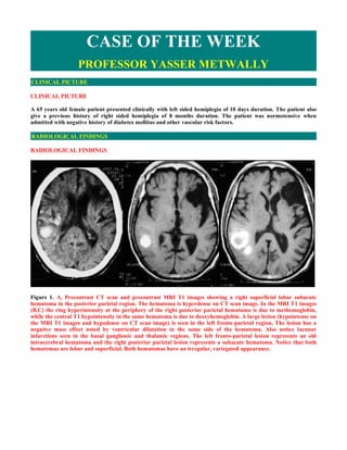 CASE OF THE WEEK
                   PROFESSOR YASSER METWALLY
CLINICAL PICTURE

CLINICAL PICTURE

A 65 years old female patient presented clinically with left sided hemiplegia of 10 days duration. The patient also
give a previous history of right sided hemiplegia of 8 months duration. The patient was normotensive when
admitted with negative history of diabetes mellitus and other vascular risk factors.

RADIOLOGICAL FINDINGS

RADIOLOGICAL FINDINGS  




Figure 1. A, Precontrast CT scan and precontrast MRI T1 images showing a right superficial lobar subacute
hematoma in the posterior parietal region. The hematoma is hyperdense on CT scan image. In the MRI T1 images
(B,C) the ring hyperintensity at the periphery of the right posterior parietal hematoma is due to methemoglobin,
while the central T1 hypointensity in the same hematoma is due to deoxyhemoglobin. A large lesion (hypointense on
the MRI T1 images and hypodense on CT scan image) is seen in the left fronto-parietal region, The lesion has a
negative mass effect noted by ventricular dilatation in the same side of the hematoma. Also notice lacunar
infarctions seen in the basal ganglionic and thalamic regions. The left fronto-parietal lesion represents an old
intracerebral hematoma and the right posterior parietal lesion represents a subacute hematoma. Notice that both
hematomas are lobar and superficial. Both hematomas have an irregular, variegated appearance.
 