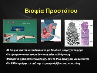 Βιοψία Προστάτου Η Βιοψία γίνεται κατευθυνόμενα με διορθικό υπερηχογράφημα Το αρνητικό αποτέλεσμα δεν αποκλείει τη διάγνωση Μπορεί να χρειασθεί επανάληψη, εάν το  PSA  συνεχίσει να ανεβαίνει Το 75% προέρχεται από την περιφερική ζώνη του προστάτη 