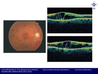 Levine-Berebichez A. Et al. Bevacizumab (Avastin)   treo en edema macular secundario a   n de vena central de la
retinaRev Mex Oftalmol 2009; 83(1):18-25
 