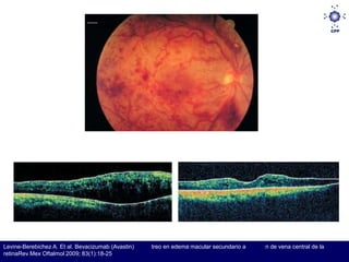 Levine-Berebichez A. Et al. Bevacizumab (Avastin)   treo en edema macular secundario a   n de vena central de la
retinaRev Mex Oftalmol 2009; 83(1):18-25
 
