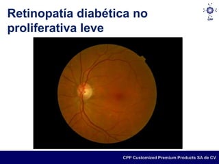 Retinopatía diabética no
proliferativa leve




                   CPP Customized Premium Products SA de CV
 
