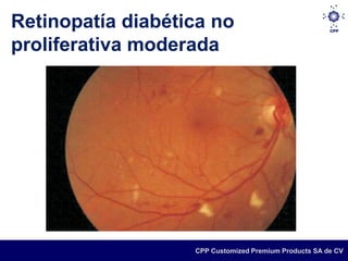 Retinopatía diabética no
proliferativa moderada




                   CPP Customized Premium Products SA de CV
 