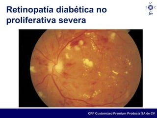 Retinopatía diabética no
proliferativa severa




                   CPP Customized Premium Products SA de CV
 