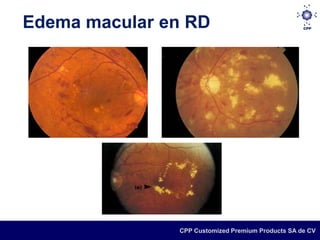 Edema macular en RD




               CPP Customized Premium Products SA de CV
 