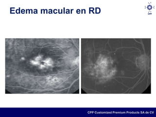 Edema macular en RD




                CPP Customized Premium Products SA de CV
 