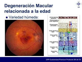 Degeneración Macular
relacionada a la edad
   Variedad húmeda:




                       CPP Customized Premium Products SA de CV
 