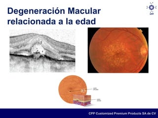 Degeneración Macular
relacionada a la edad
   Variedad húmeda:




                       CPP Customized Premium Products SA de CV
 