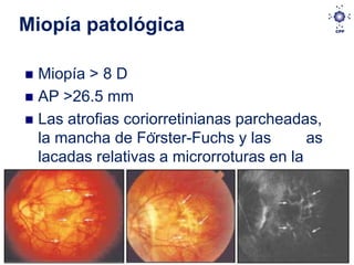 Miopía patológica

 Miopía > 8 D
 AP >26.5 mm
 Las atrofias coriorretinianas parcheadas,
  la mancha de Förster-Fuchs y las       as
  lacadas relativas a microrroturas en la
  membrana de Bruch.
 