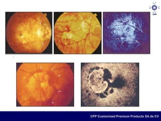  Miopía > 6 D
 AP >26.5 mm
 Las atrofias coriorretinianas parcheadas,
  la mancha de Förster-Fuchs y las       as
  lacadas relativas a microrroturas en la
  membrana de Bruch.



                         CPP Customized Premium Products SA de CV
 