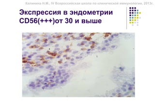 Калинина Н.М., IV Всероссийская школа по клинической иммунологии, 2013г.


Экспрессия в эндометрии
CD56(+++)от 30 и выше
 