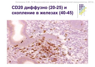 Калинина Н.М., IV Всероссийская школа по клинической иммунологии, 2013г.


CD20 диффузно (20-25) и
скопление в железах (40-45)
 