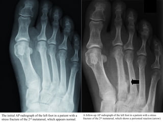 The initial AP radiograph of the left foot in a patient with a
stress fracture of the 2nd
metatarsal, which appears normal.
A follow-up AP radiograph of the left foot in a patient with a stress
fracture of the 2nd
metatarsal, which shows a periosteal reaction (arrow)
 