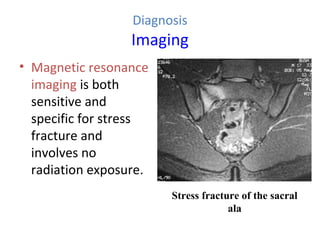 Diagnosis
Imaging
• Magnetic resonance
imaging is both
sensitive and
specific for stress
fracture and
involves no
radiation exposure.
Stress fracture of the sacral
ala
 