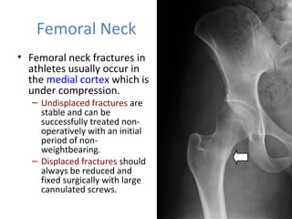 Femoral Neck
• Femoral neck fractures in
athletes usually occur in
the medial cortex which is
under compression.
– Undisplaced fractures are
stable and can be
successfully treated non-
operatively with an initial
period of non-
weightbearing.
– Displaced fractures should
always be reduced and
fixed surgically with large
cannulated screws.
 