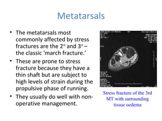 Metatarsals
• The metatarsals most
commonly affected by stress
fractures are the 2nd
and 3rd
–
the classic ‘march fracture.’
• These are prone to stress
fracture because they have a
thin shaft but are subject to
high levels of strain during the
propulsive phase of running.
• They usually do well with non-
operative management.
Stress fracture of the 3rd
MT with surrounding
tissue oedema
 