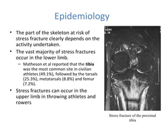 Epidemiology
• The part of the skeleton at risk of
stress fracture clearly depends on the
activity undertaken.
• The vast majority of stress fractures
occur in the lower limb.
– Matheson et al reported that the tibia
was the most common site in civilian
athletes (49.1%), followed by the tarsals
(25.3%), metatarsals (8.8%) and femur
(7.2%).
• Stress fractures can occur in the
upper limb in throwing athletes and
rowers
Stress fracture of the proximal
tibia
 