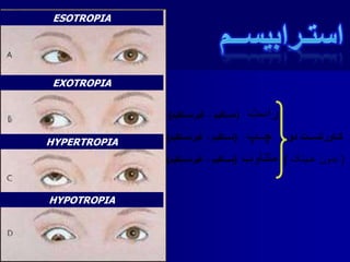 ESOTROPIA
EXOTROPIA
HYPERTROPIA
HYPOTROPIA
 