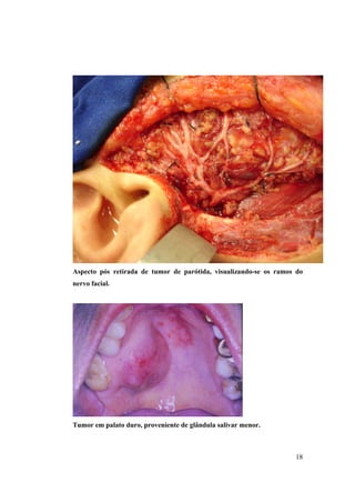 18
Aspecto pós retirada de tumor de parótida, visualizando-se os ramos do
nervo facial.
Tumor em palato duro, proveniente de glândula salivar menor.
 