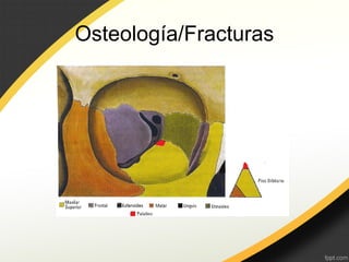 Osteología/Fracturas
 