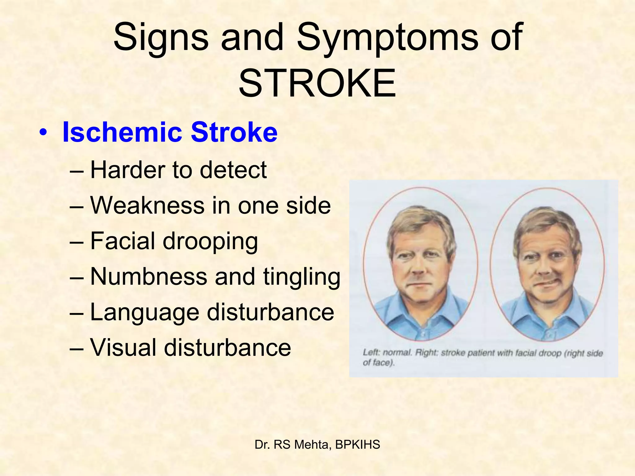 1 Cva Or Stroke Ppt
