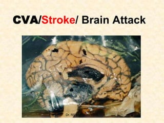 CVA/Stroke/ Brain Attack

Dr. RS Mehta, BPKIHS

 