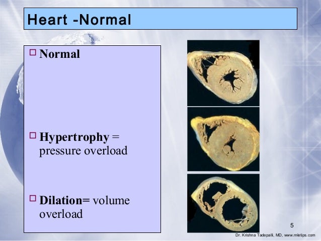 Pressure Overload Vs Volume Overload – ILTCN