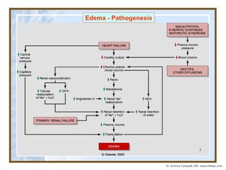 Edema - Pathogenesis

4

Dr. Krishna Tadepalli, MD, www.mletips.com

 