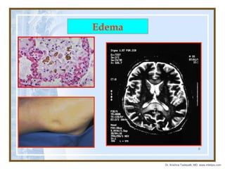 Edema

6

Dr. Krishna Tadepalli, MD, www.mletips.com

 