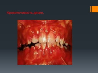Кровоточивость десен,

 