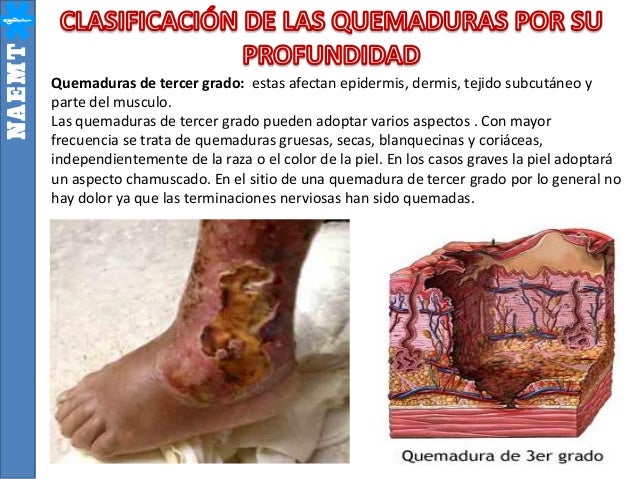 1. quemaduras psf 1. quemaduras psf