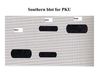 Southern blot for PKU

 