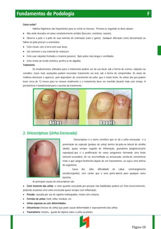 Fundamentos de Podologia

F

Como evitar?
Hábitos higiênicos são importantes para se evitar as micoses. Previna-se seguindo as dicas abaixo:

• Não ande descalço em pisos constantemente úmidos (lava pés, vestiários, saunas).
• Observe a pele e o pêlo de seus animais de estimação (cães e gatos). Qualquer alteração como descamação ou
falhas no pêlo procure o veterinário.

• Evite mexer com a terra sem usar luvas.
• Use somente o seu material de manicure.
• Evite usar calçados fechados o máximo possível. Opte pelos mais largos e ventilados.
• Evite meias de tecido sintético, prefira as de algodão.
Tratamento
Os medicamentos utilizados para o tratamento podem ser de uso local, sob a forma de cremes, soluções ou
esmaltes. Casos mais avançados podem necessitar tratamento via oral, sob a forma de comprimidos. Os sinais de
melhora demoram a aparecer, pois dependem do crescimento da unha, que é muito lento. As unhas dos pés podem
levar cerca de 12 meses para se renovar totalmente e o tratamento deve ser mantido durante todo este tempo. A
persistência é fundamental para o sucesso do tratamento.

2. Onicocriptose (Unha Encravada)
Onicocriptose é o nome científico que se dá a unha encravada : é a
penetração de espícula (pedaço de unha) dentro da pele,na lateral do artelho
(dedo), quase sempre seguido de inflamação, granuloma piogênico(carne
esponjosa) que é a proliferação de vasos sanguíneos formando uma lesão
tumoral secundária ,de cor avermelhada ou arrouxeada, úmida,de consistência
mole e que sangra facilmente,depois de um traumatismo ,ou seja,é uma defesa
do organismo.
Causa

dor,

odor,

dificuldade

de

calçar,

constrangimento

social(vergonha), sem contar que é uma porta aberta para qualquer outra
bactéria.
As principais causas de onicocriptose são:
•

Corte incorreto das unhas: o corte quando executado por pessoas não habilitadas poderá ser feito incorretamente,

podendo ocasionar uma unha encravada quase sempre com inflamação.
•

Pressão: causada por uso de sapatos inadequados, meias com costuras.

•

Formato de unhas: funil, telha, involuta, etc.

•

Unhas espessas ou com deformidades,

•

Onicomicose (micose de unha) que pode causar deformidade e espessamento das unhas.

•

Traumatismo: torções, queda de objetos sobre a unha ou pisões.

Página 18

 