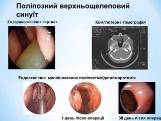Поліпозний верхньощелеповий
синуїт
Ендориноскопічна картина

Комп’ютерна томографія

Ендоскопічна малоінвазивна поліпоетмоїдогайморотомія

1 день після операції

30 день після операц

 