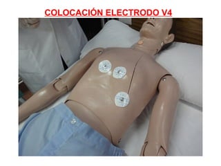 COLOCACIÓN ELECTRODO V4

 