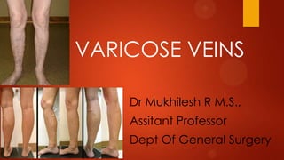 VARICOSE VEINS
Dr Mukhilesh R M.S.,

Assitant Professor
Dept Of General Surgery

 