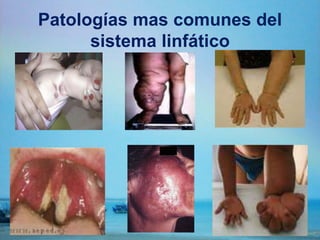 Patologías mas comunes del
sistema linfático
 